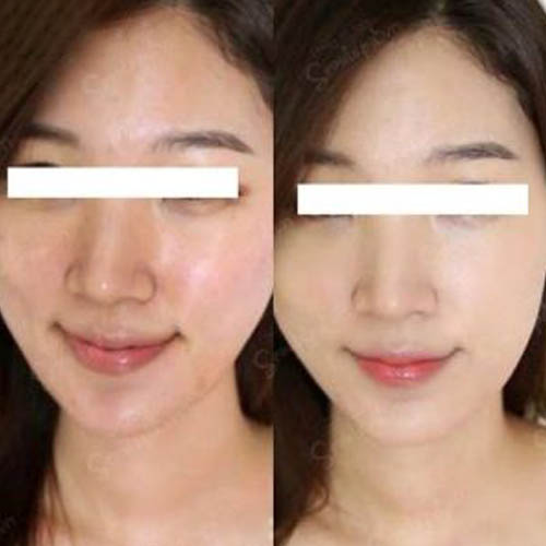 Ly no longer spends money on many expensive cosmetics because now her face has become more acne-free and radiant when she comes to Dr Anna Khanh for acne treatment.