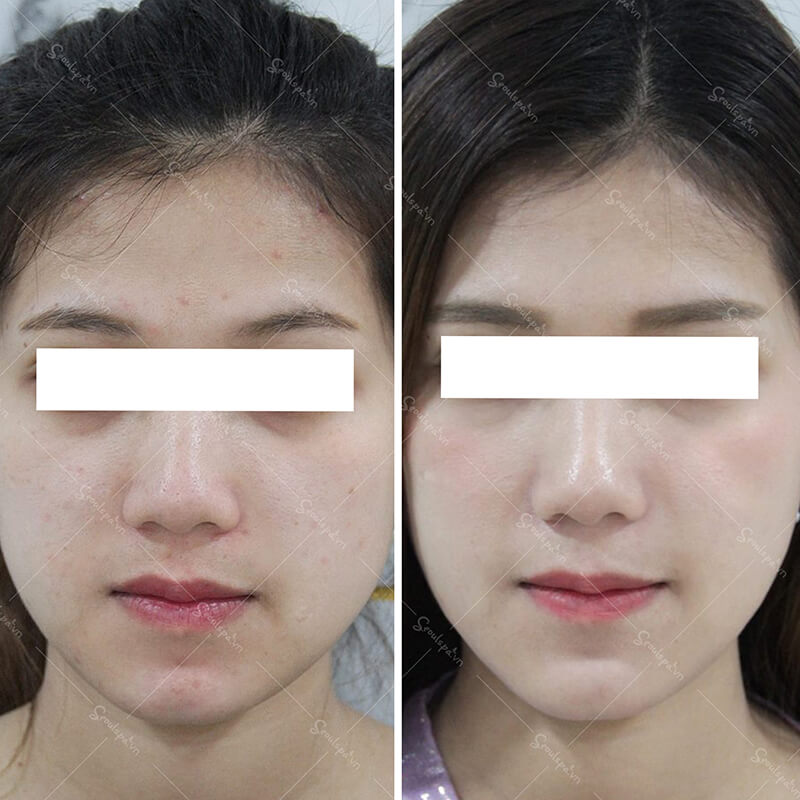 Ly no longer spends money on many expensive cosmetics because now her face has become more acne-free and radiant when she comes to Dr Anna Khanh for acne treatment.
