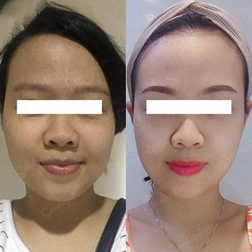 Chị Ly không còn tốn tiền cho nhiều loại mỹ phẩm đắt tiền nữa vì giờ đây gương mặt đã trở nên sạch mụn và rạng rỡ hơn khi đến Dr Anna Khanh điều trị mụn